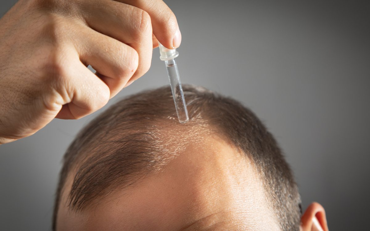 Balding – Warning signs, causes, and management options